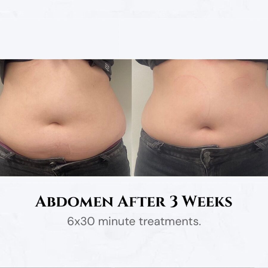 Abdomen results after 6 sessions