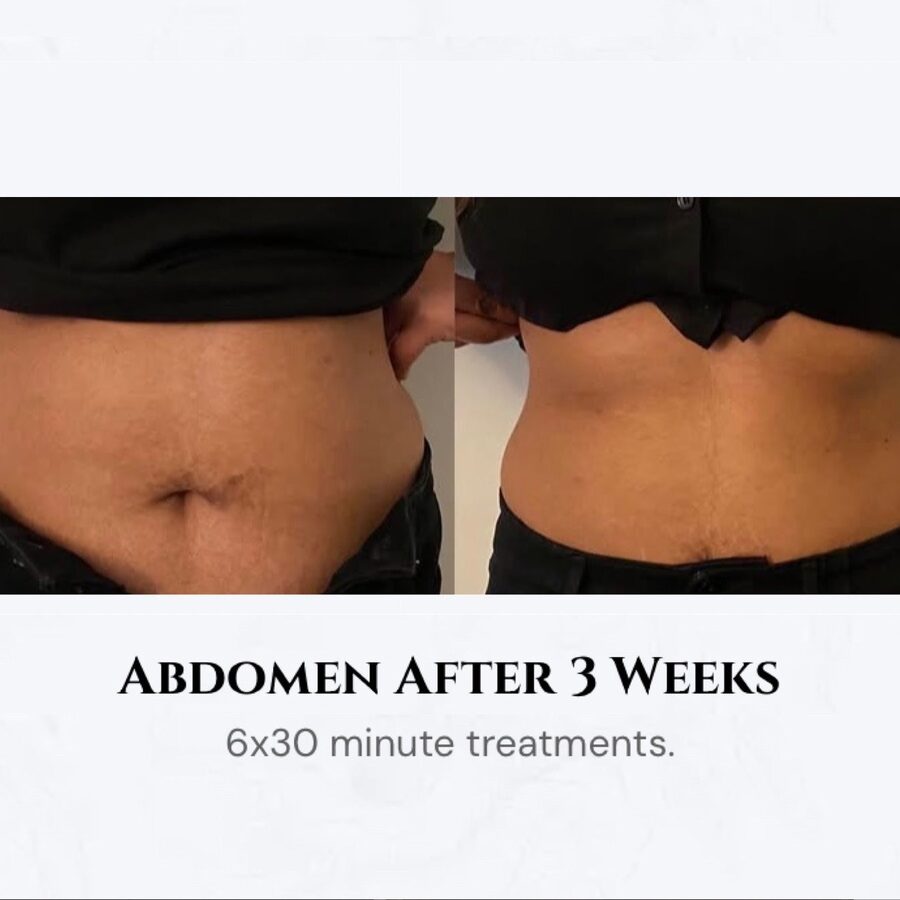 Body contouring results