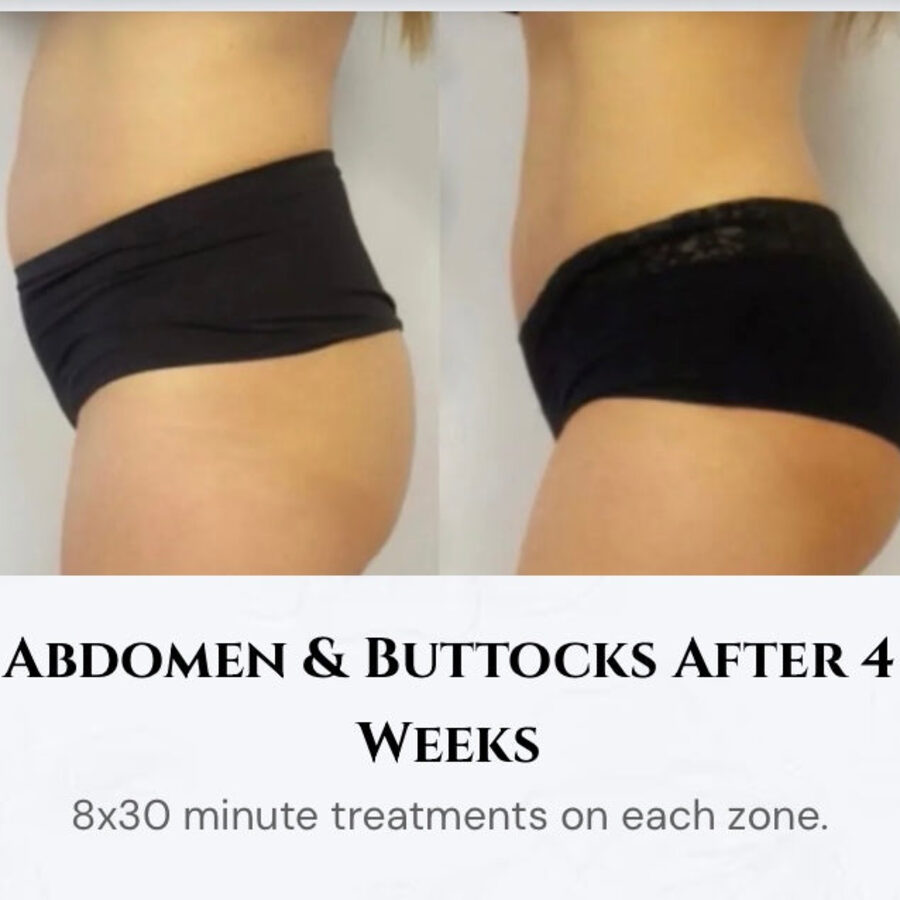 Body contouring result